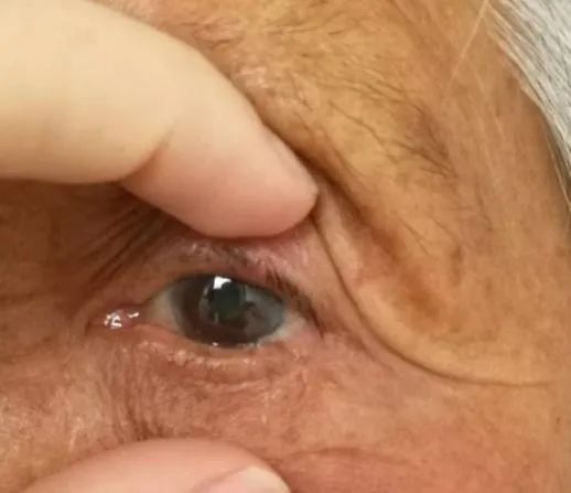 眼整形常见手术方式,眼整形美容手术