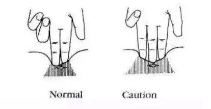 自曝产后尿失禁的危害,明星自曝产后后遗症