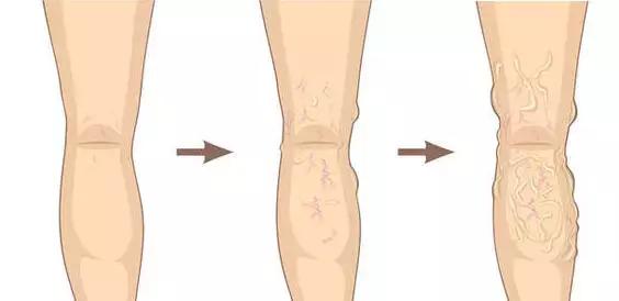 腿上有蚯蚓纹怎么回事,腿上出现蚯蚓似的纹路是怎么回事
