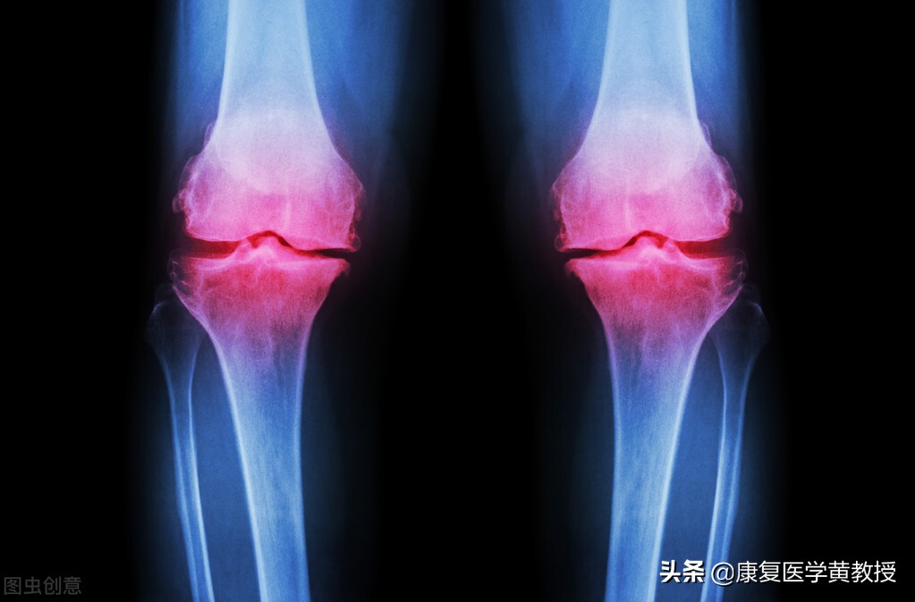 什么药物或者膏药可以缓解骨刺,骨刺贴膏药能除去骨刺吗