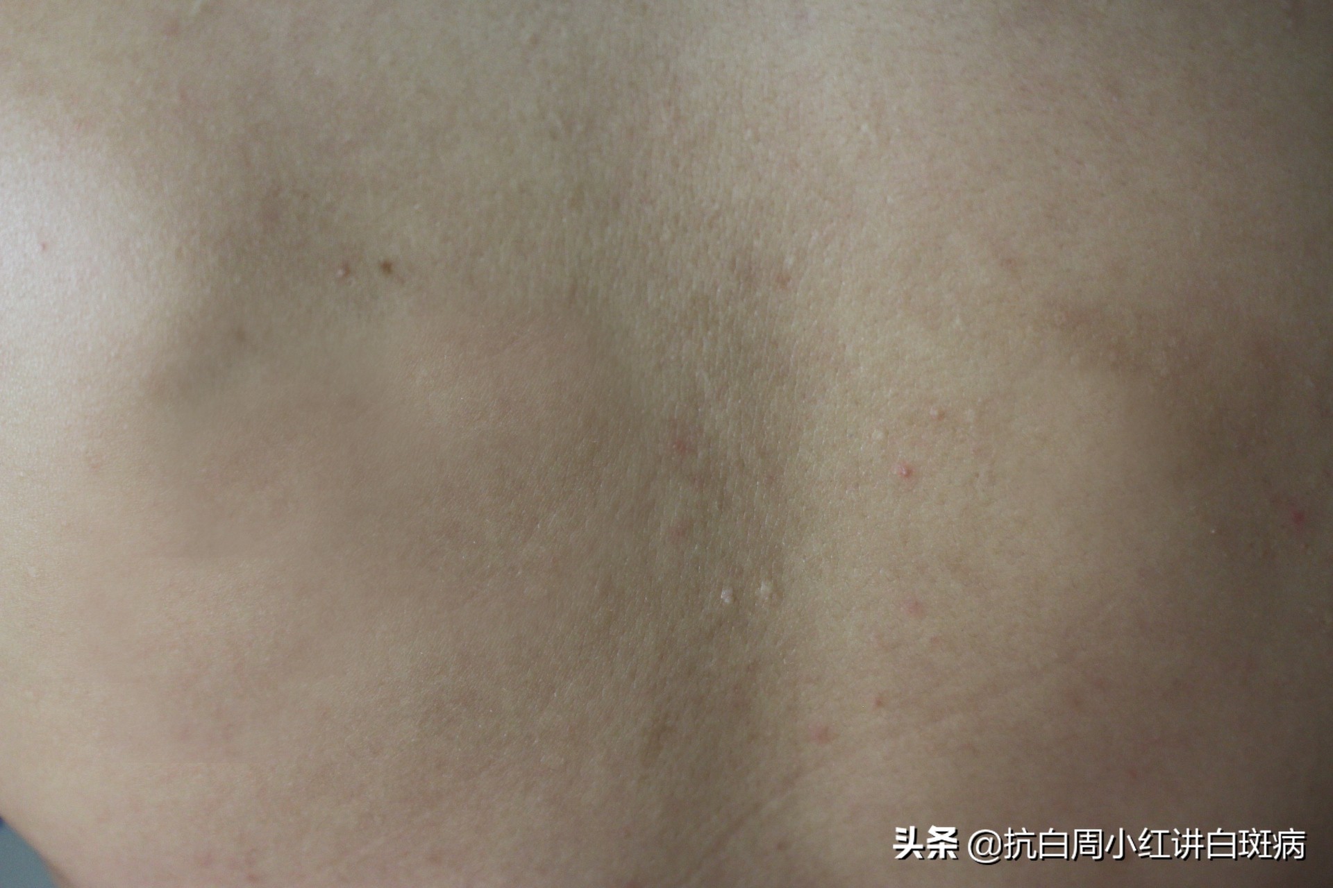 白癜风患者治好的全过程,白癜风治愈患者分享痊愈经验