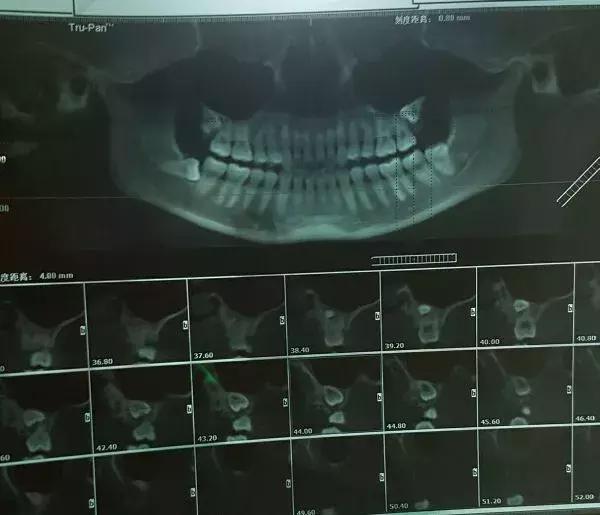 那些不拔智齿的人后来都怎么样了,那些该拔不拔的智齿最后都咋样了