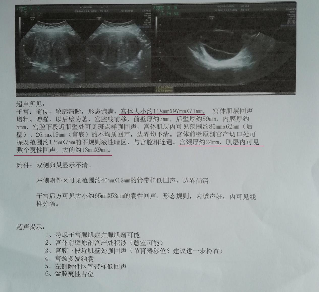 有一次剖腹产过第二次剖腹产会痛,熬过了剖宫产之后的痛
