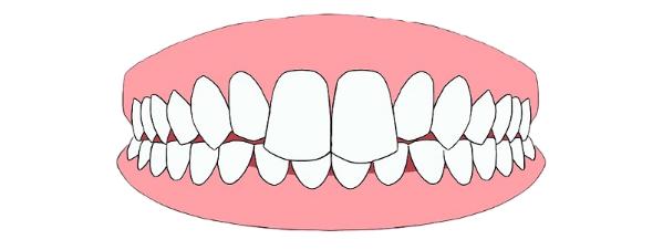 带你了解超详细的牙齿矫正过程,牙齿矫正全过程看完你就知道