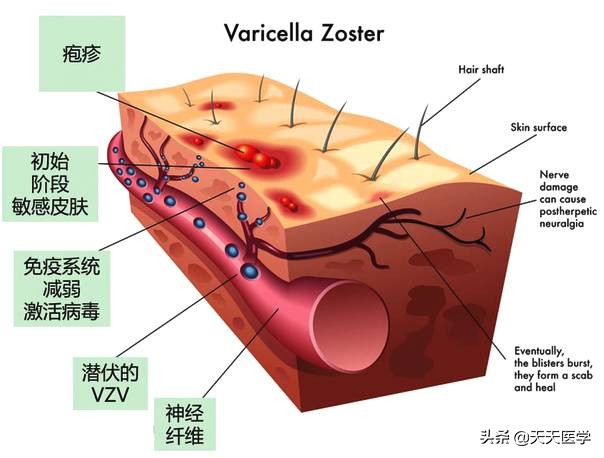 带状疱疹治愈后两年还有神经痛吗,带状疱疹后遗神经痛最新疗法