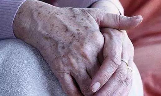 52岁脸上出现老年斑怎么办,47岁脸上有老年斑怎么治