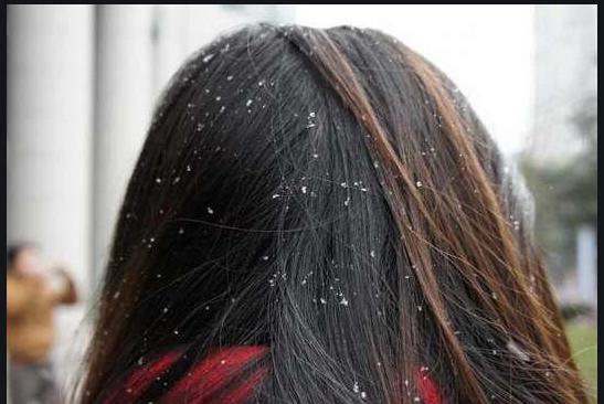 头发爱出油和掉头发妙招,头发上有头螨怎么消除