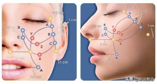 5000元的线雕和5000元线雕的区别,5万元线雕价格