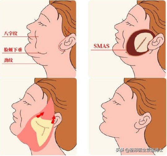 拉皮手术的四大优势,拉皮手术热议