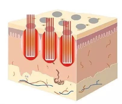 点阵激光祛陈旧疤痕有用吗,点阵激光治疗痘坑真的有用吗