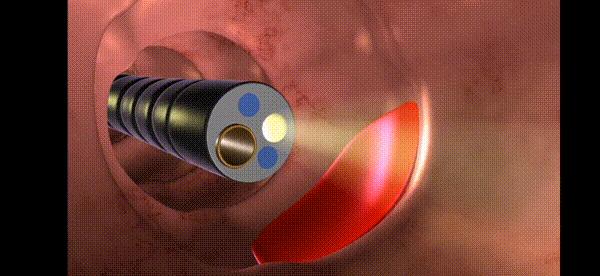 结肠镜检查送什么礼物,结肠镜老年人