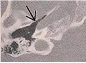 科普如何正确认识耳鸣,科普文的趣味性