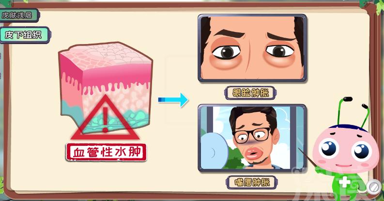 麻疹发病机制,荨麻疹发病机理