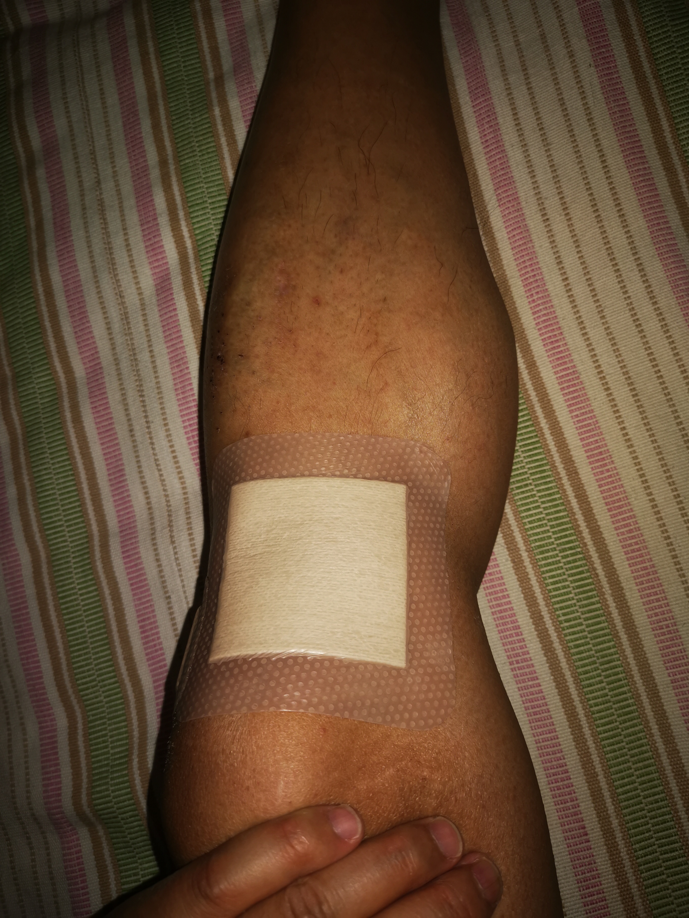 疤痕贴瑞典墨尼克术后多久用,瑞典墨尼克美皮护