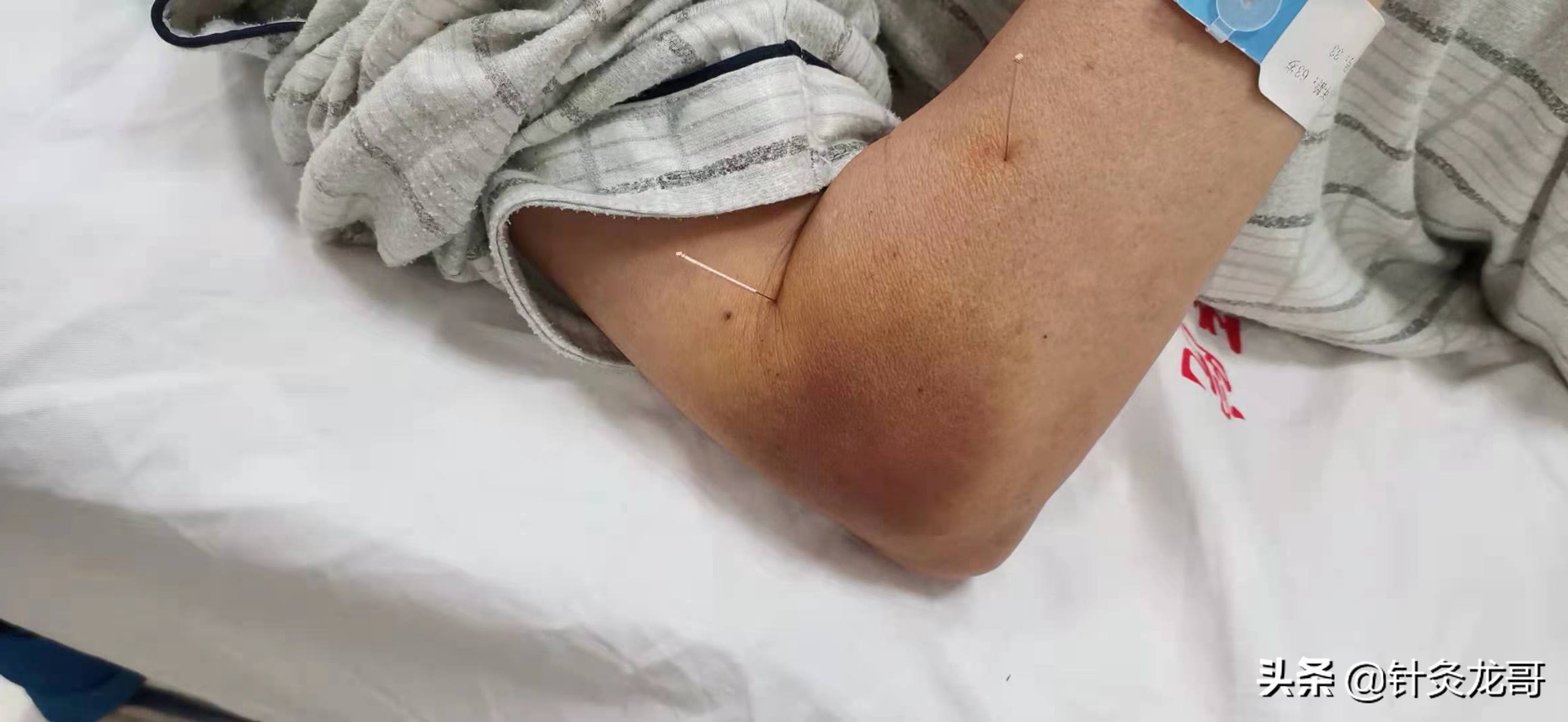 针灸出现淤青怎么处理,针灸出现淤青是不是血瘀了