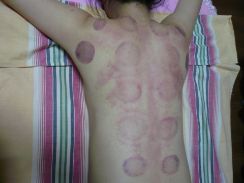 感冒刮痧拔罐的好处和坏处,拔罐刮痧艾灸哪个祛湿气好