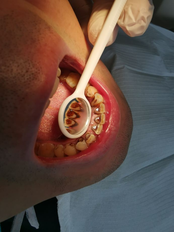 洗牙到底好不好,喷砂洗牙到底好不好