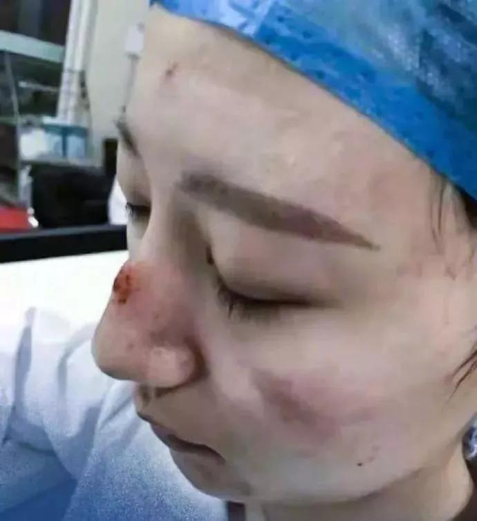 口罩压破脸怎么办,戴口罩皮肤被磨伤了怎么办