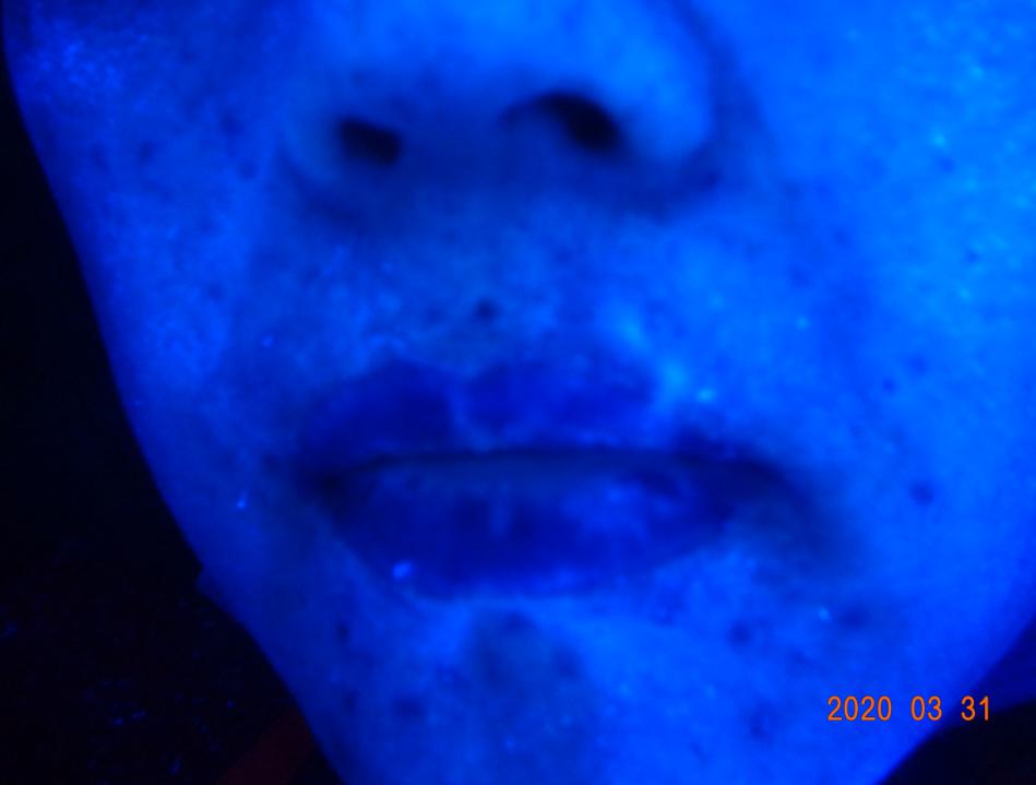 一位散发型白癜风患者的自白：坚持治疗能痊愈，千万别放弃自己