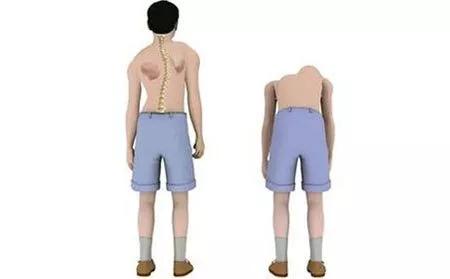 强直女性一般多少岁就不发展了,强直男性和女性有不同吗