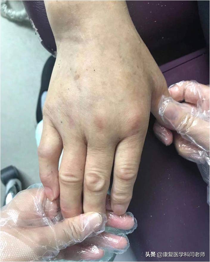 脑卒中后偏瘫患者常见并发症:肩手综合征的康复治疗