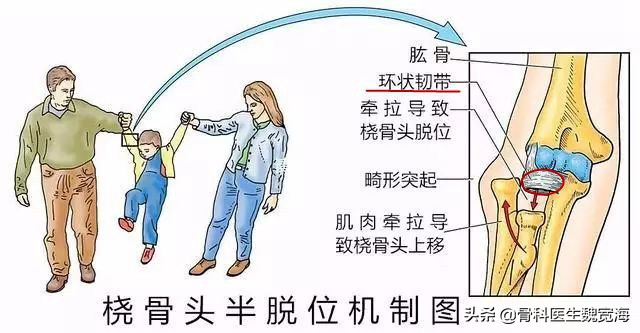 小孩子手臂脱臼最佳处理时间,孩子手臂脱臼急救法