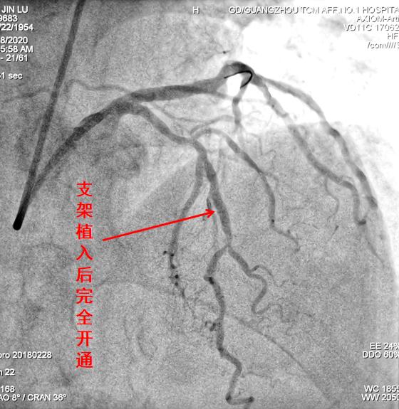 心肌缺血心肌梗死怎么检查,心肌梗死怎么样急救