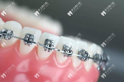 南京整牙哪家医院好多少钱,南京成人隐形整牙多少钱