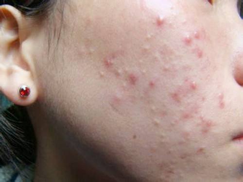 洗脸放白糖真的可以祛痘痘印吗,白糖洗脸祛痘痘吗