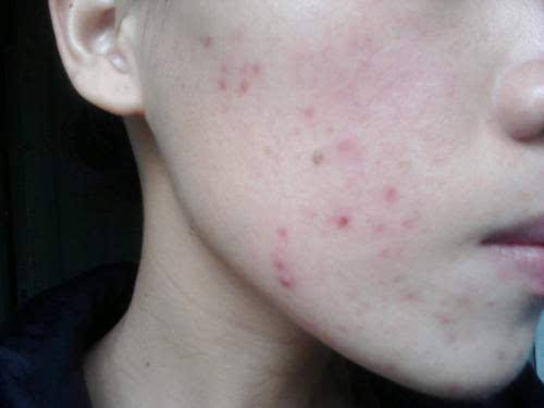 黑痘印与红痘印区别,深色痘印和红色痘印区别