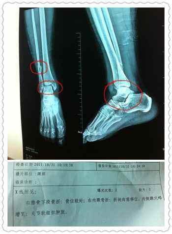 长期脚脖肿怎么回事,脚脖子肿疼用什么能好得快