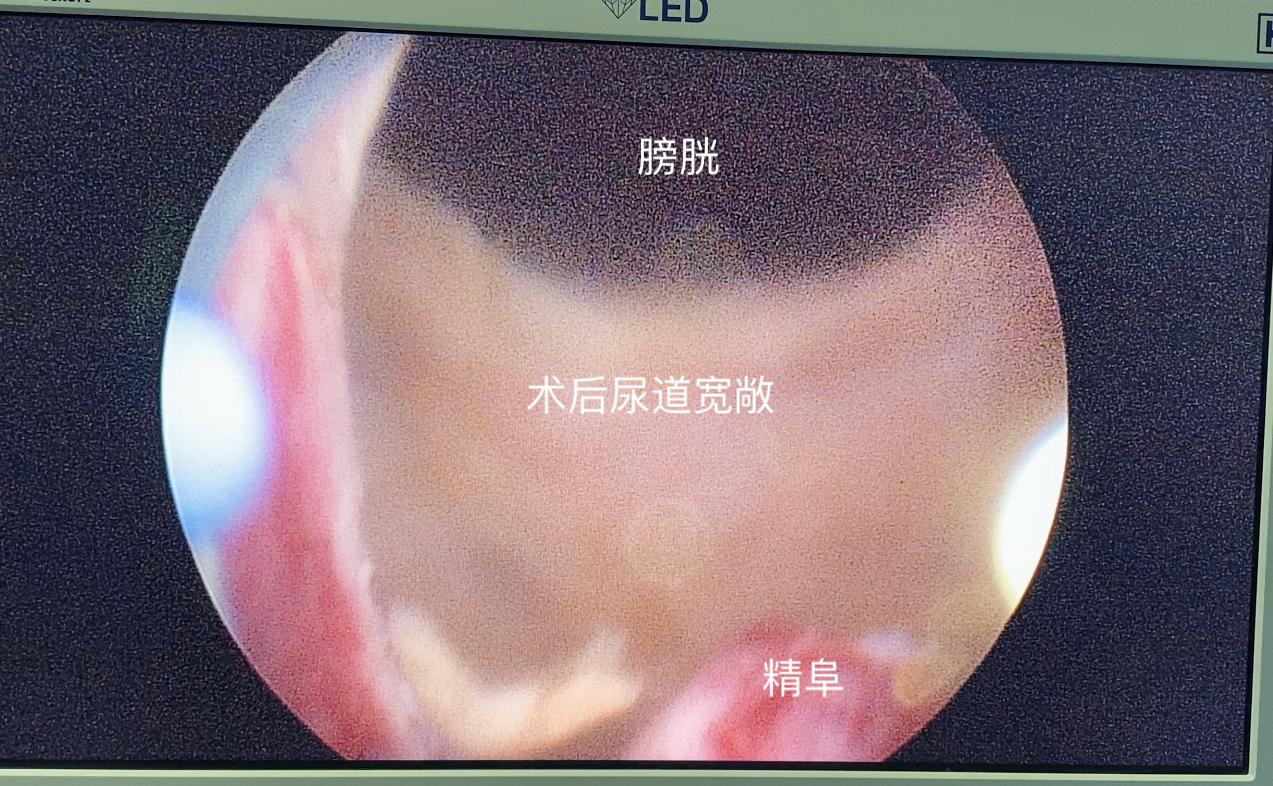 前列腺增生膀胱有余尿如何做手术,前列腺增生是结石吗