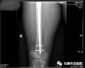 石狮市骨科医院,石狮市总医院骨科多少钱