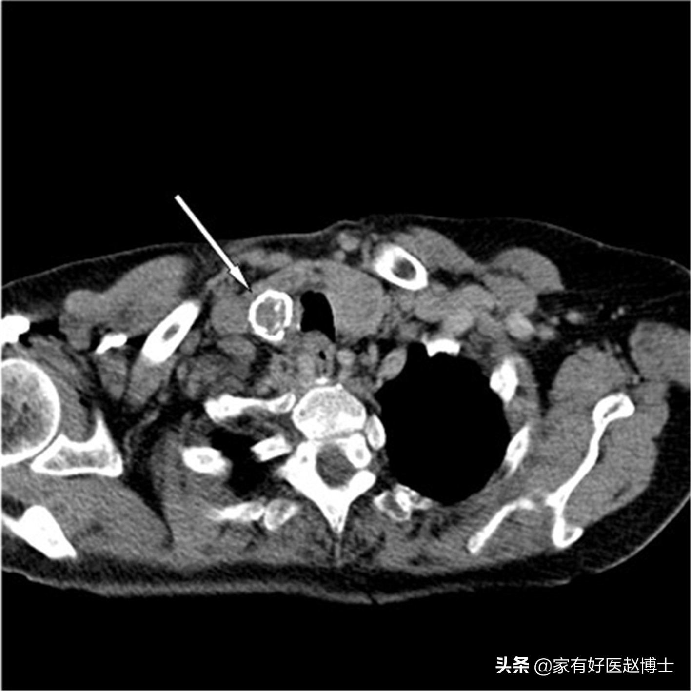 体检报告中常出现钙化哪些需警惕,钙化有什么症状和危害