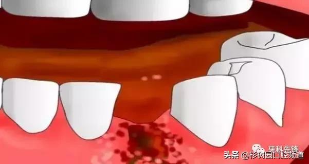 牙疼的滋味没人能理解,牙疼的痛苦有谁能够体会