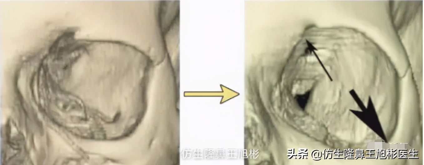 隆鼻怎么做才能让鼻型更好看,隆鼻后变老变丑