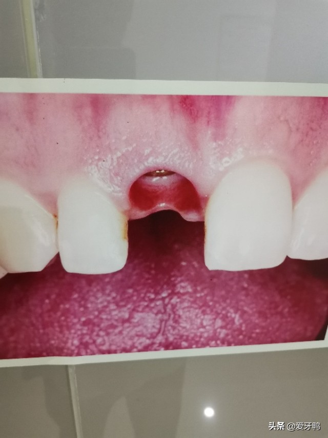 小孩被牙齿磕到头怎么办,小孩磕到牙齿出血怎么办