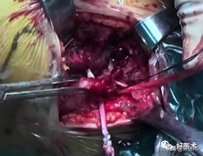 治疗肩锁关节脱位，有最好的方法吗？