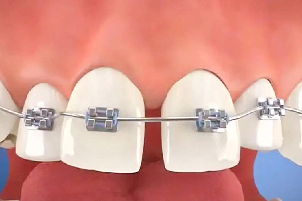 牙缝又大又难看还显老,牙缝大怎么修图