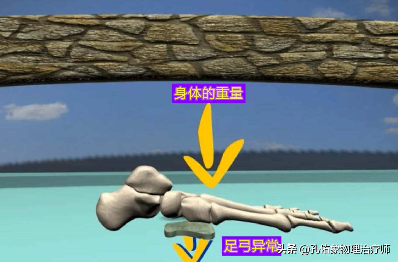 如何治疗足底筋膜炎缓解疼痛,足跟痛筋膜炎最佳的治疗办法