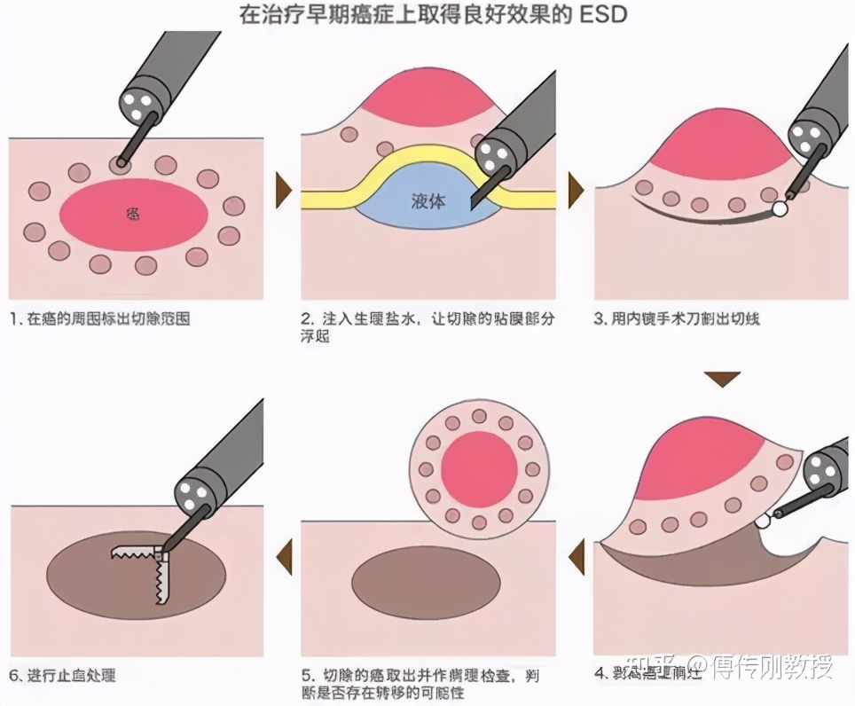 经肛直肠良性肿物切除手术怎么做,直肠大息肉切除的技术和费用