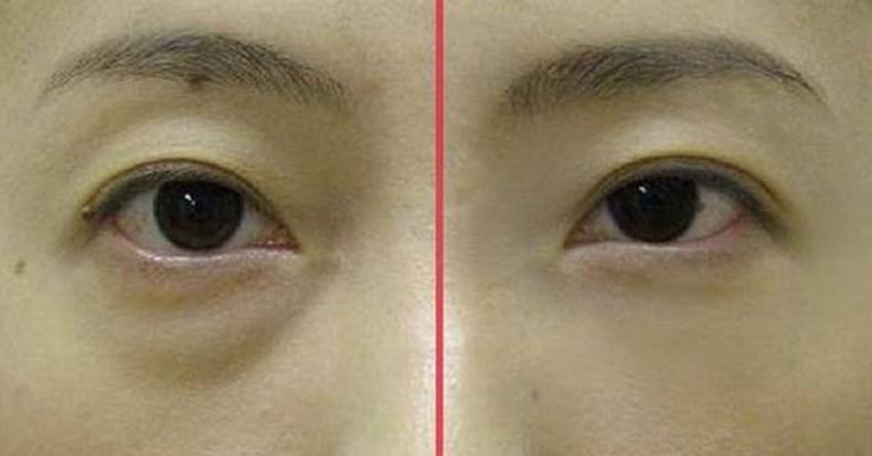 卧蚕和眼袋傻傻分不清的说说,眼袋卧蚕泪沟傻傻分不清楚