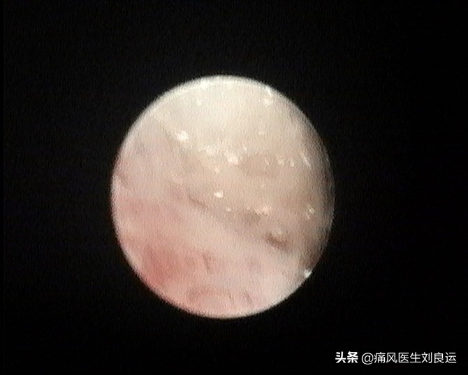 痛风真的中医可以治疗吗,痛风是类风湿唯一可治愈的病