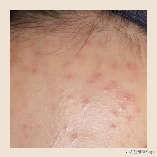 挤痘一定要挤出血吗,徒手挤了痘痘怎么办