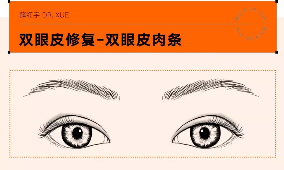 双眼皮整形修复,潘贰双眼皮修复