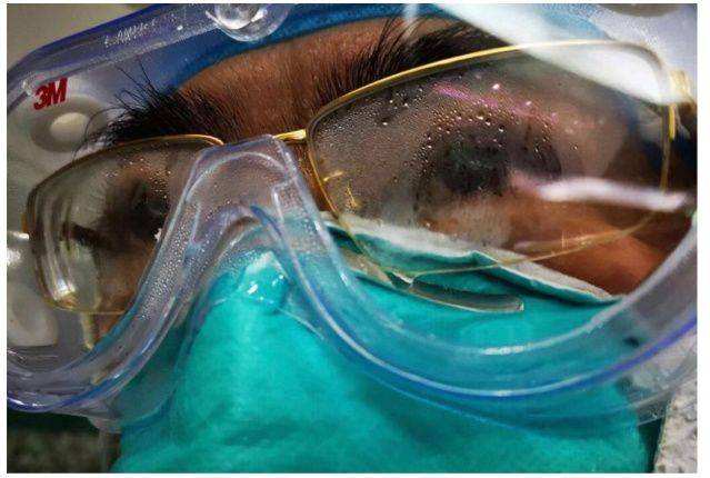 如何预防护目镜压伤,防止护目镜内起雾小妙招