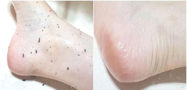 洗澡搓泥后起疙瘩,洗澡时搓出来的泥是怎么回事