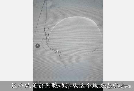 医生给你用图片讲解：前列腺增生如何微创治疗，一看就懂！