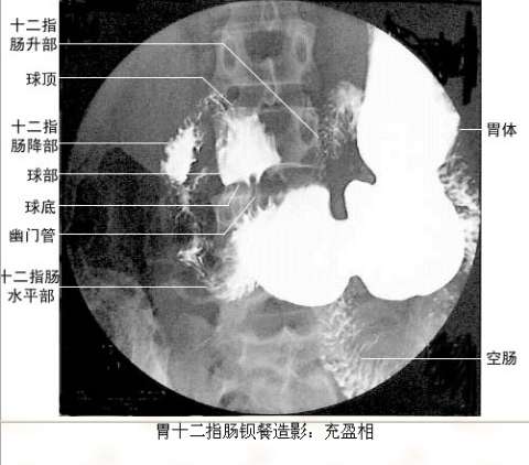 胃部钡餐和胃镜哪个好,胃部钡餐和胃镜的区别