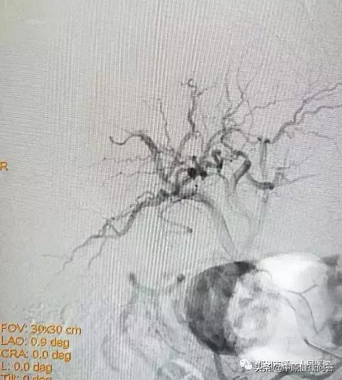 肝癌黄疸可以介入栓塞和灌注,肝癌栓塞介入手术后尿液发红
